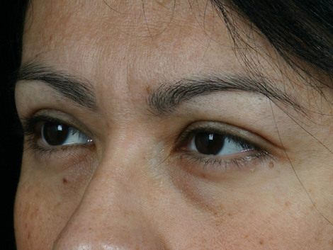 Injectable Fillers before and after photo