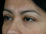 Injectable Fillers Before and after photo