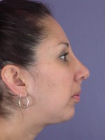 Nose Reshaping Before and after photo