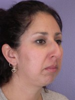 Nose Reshaping Before and after photo