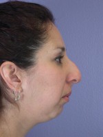 Nose Reshaping Before and after photo