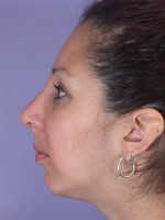 Nose Reshaping Before and after photo