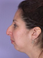 Nose Reshaping Before and after photo