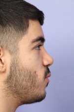 Nose Reshaping Before and after photo