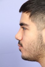 Nose Reshaping Before and after photo