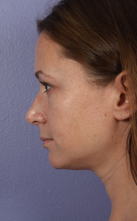 Nose Reshaping before and after photo