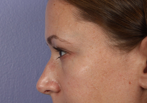 Nose Reshaping before and after photo