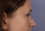 Nose Reshaping Before and after photo