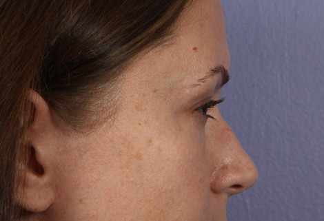 Nose Reshaping before and after photo