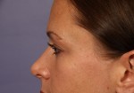 Nose Reshaping Before and after photo