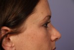 Nose Reshaping Before and after photo