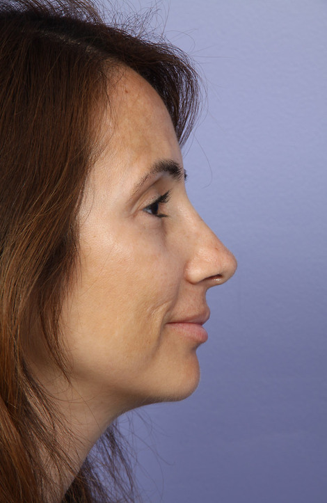 Nose Reshaping before and after photo