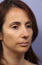 Nose Reshaping Before and after photo