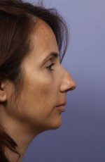 Nose Reshaping Before and after photo