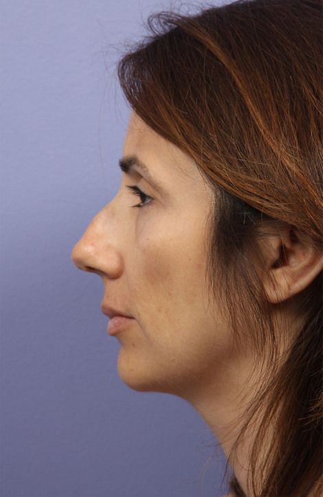 Nose Reshaping before and after photo