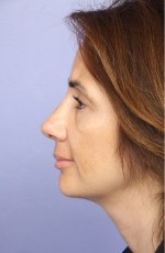 Nose Reshaping Before and after photo