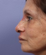 Nose Reshaping Before and after photo