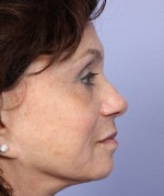 Nose Reshaping Before and after photo