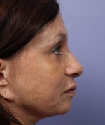 Nose Reshaping Before and after photo