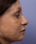 Nose Reshaping Before and after photo