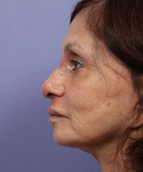 Nose Reshaping before and after photo