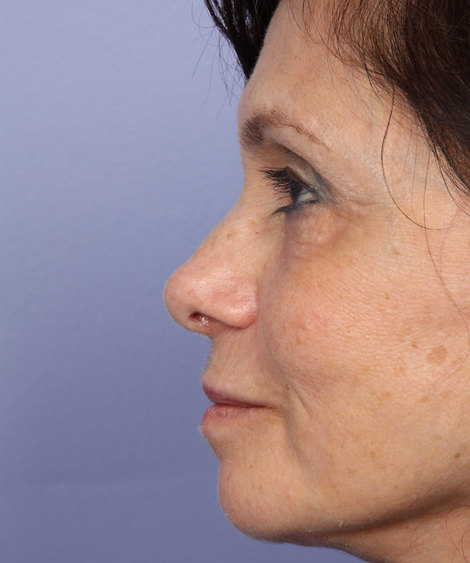 Nose Reshaping before and after photo