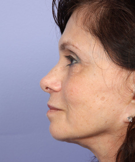 Nose Reshaping before and after photo