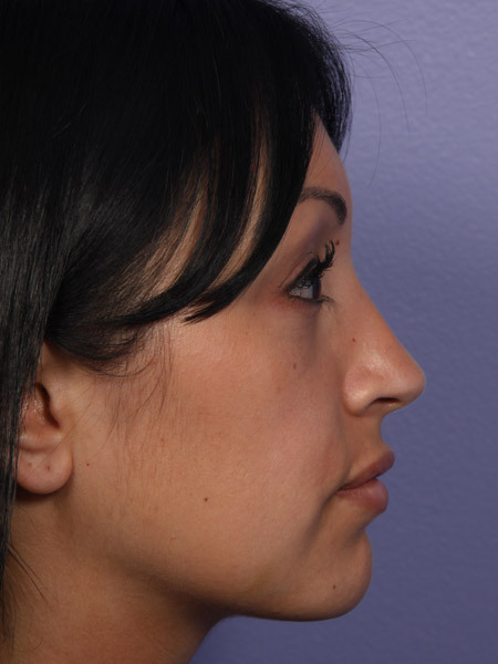 Nose Reshaping before and after photo