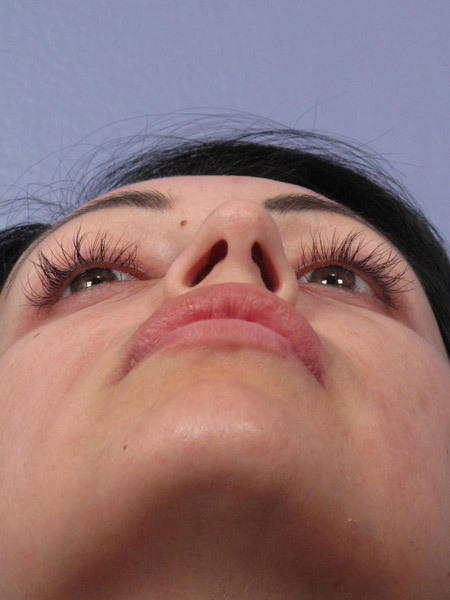 Nose Reshaping before and after photo