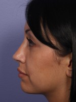 Nose Reshaping Before and after photo