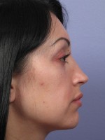 Nose Reshaping Before and after photo