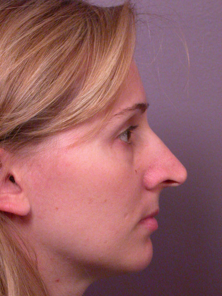 Nose Reshaping before and after photo