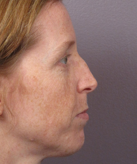 Nose Reshaping before and after photo