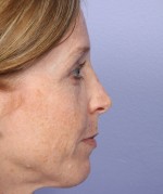 Nose Reshaping Before and after photo