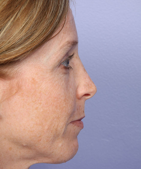 Nose Reshaping before and after photo