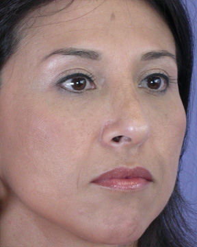 Nose Reshaping before and after photo