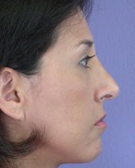 Nose Reshaping Before and after photo