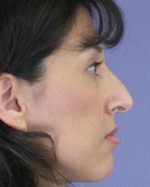 Nose Reshaping