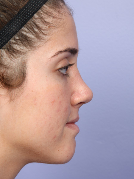 Nose Reshaping before and after photo