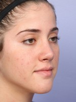 Nose Reshaping