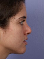 Nose Reshaping Before and after photo