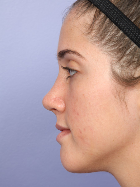 Nose Reshaping before and after photo