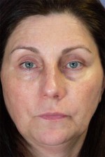 Injectable Fillers Before and after photo