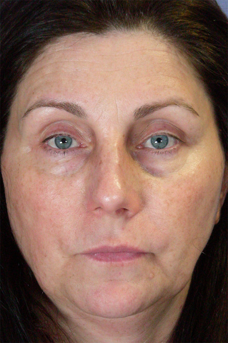 Injectable Fillers before and after photo