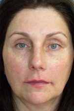 Injectable Fillers Before and after photo