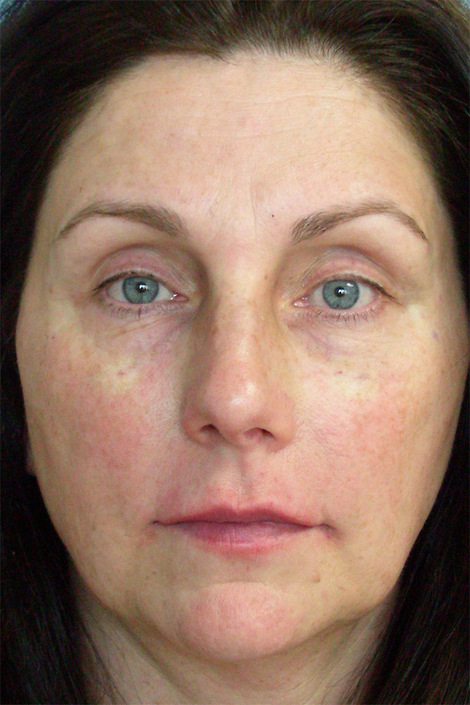 Injectable Fillers before and after photo