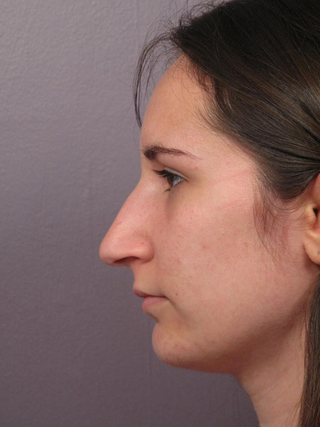 Nose Reshaping before and after photo