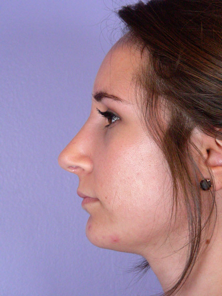 Nose Reshaping before and after photo