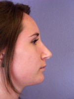 Nose Reshaping Before and after photo