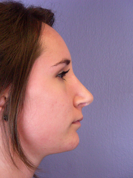 Nose Reshaping before and after photo